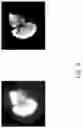 Fig. 06 - Liver cancer detection