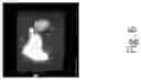 Fig. 07 - Liver cancer detection
