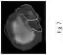 Fig. 08 - Liver cancer detection