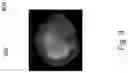 Fig. 09 - Liver cancer detection