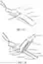 Fig. 03 - Needle electrode fixation device and associated methods