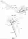 Fig. 04 - Needle electrode fixation device and associated methods
