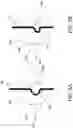 Fig. 07 - Stabilizing wires for medical device