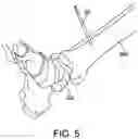 Fig. 08 - Ankle replacement system and method