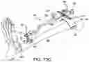 Fig. 14 - Ankle replacement system and method