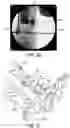 Fig. 18 - Ankle replacement system and method