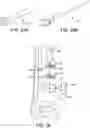Fig. 21 - Ankle replacement system and method