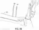 Fig. 23 - Ankle replacement system and method