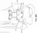 Fig. 33 - Ankle replacement system and method