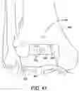 Fig. 38 - Ankle replacement system and method