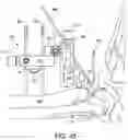 Fig. 42 - Ankle replacement system and method