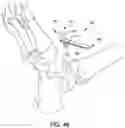 Fig. 45 - Ankle replacement system and method
