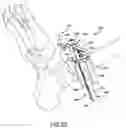 Fig. 47 - Ankle replacement system and method