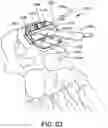 Fig. 60 - Ankle replacement system and method