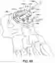 Fig. 62 - Ankle replacement system and method