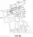 Fig. 65 - Ankle replacement system and method