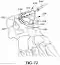 Fig. 67 - Ankle replacement system and method