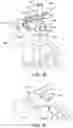 Fig. 68 - Ankle replacement system and method