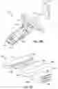 Fig. 76 - Ankle replacement system and method