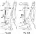 Fig. 80 - Ankle replacement system and method