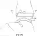 Fig. 83 - Ankle replacement system and method