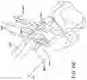 Fig. 84 - Ankle replacement system and method