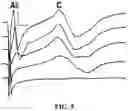 Fig. 06 - Simultaneous multi-site vagus nerve neuromodulation for improved glycemic control system and methods
