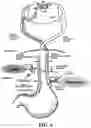 Fig. 07 - Simultaneous multi-site vagus nerve neuromodulation for improved glycemic control system and methods
