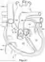 Fig. 02 - Native valve repair devices and procedures