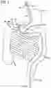 Fig. 03 - Incisionless gastric bypass system