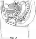 Fig. 03 - Natural orifice surgery system