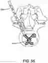 Fig. 41 - Spine surgery method and instrumentation