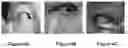 Fig. 06 - Isoxazoline parasiticide formulations and methods for treating blepharitis