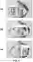 Fig. 07 - Marker-less augmented reality system for mammoplasty pre-visualization