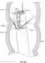 Fig. 167 - Fluid distribution device for a multiple viewing elements endoscope