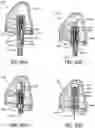 Fig. 64 - FOCUSED STERILIZATION AND STERILIZED SUB-ASSEMBLIES FOR ANALYTE MONITORING SYSTEMS