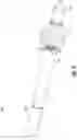 Fig. 15 - Prosthesis, delivery device and methods of use