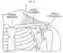 Fig. 04 - METHODS AND DEVICES FOR INHIBITING NERVES WHEN ACTIVATING BROWN ADIPOSE TISSUE