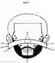 Fig. 06 - PERFECT HAIRLINER
