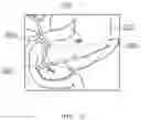 Fig. 05 - Peroral endoscopic apparatus
