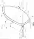 Fig. 04 - Systems and methods for treating aneurysms