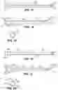 Fig. 10 - Systems and methods for treating aneurysms