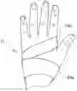 Fig. 01 - Method of transradial catheterization, device for ulnar artery compression, and method of use