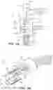 Fig. 04 - LITHOPLASTY DEVICE WITH ADVANCING ENERGY WAVEFRONT