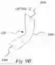 Fig. 23 - Biopsy marker with anchoring capabilities