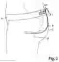 Fig. 04 - Device for the external support of the female urethra under stress