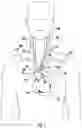 Fig. 02 - CATHETER FOR PREVENTION OF STROKE AND METHOD OF USE