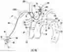 Fig. 06 - CATHETER FOR PREVENTION OF STROKE AND METHOD OF USE