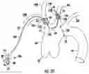 Fig. 40 - CATHETER FOR PREVENTION OF STROKE AND METHOD OF USE