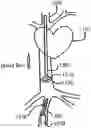 Fig. 01 - Endovascular device with expandable filter